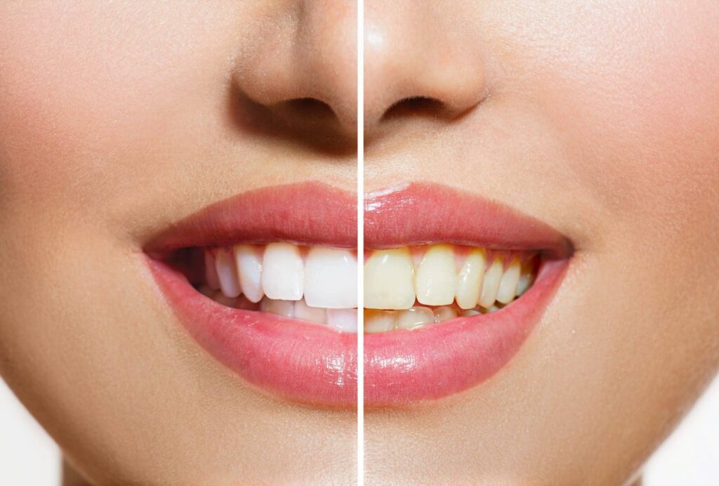 Healthy Teeth Whitening 1